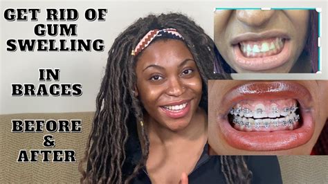 How To Get Rid Of Gum Swelling In Braces Youtube