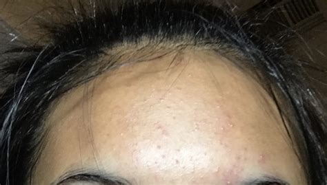 Forehead Covered In Tiny Colorless Bumps Oily Skin