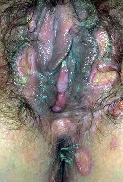 Pictures Showing For Blue Waffle Porn Mypornarchive Net