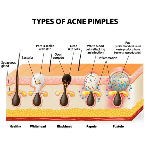 Acne Types Albany Cosmetic And Laser Centre
