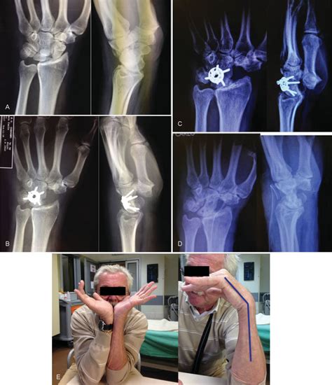 Stage Iii Scaphoid Nonunion Advance Collapse Wrist A Anteroposterior