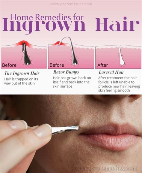 It tends to appear after hair removal by shaving or waxing and can affect both male and female persons. Home Remedies For Ingrown Hair | Ingrown hair, Ingrown ...