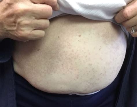 Derm Dx Rash On The Abdomen And Upper Arms Dermatology Advisor