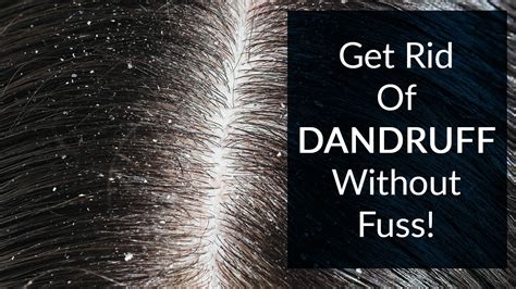 How To Get Rid Of Dandruff Youtube