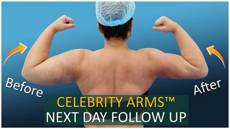 Arm Liposuction Follow Up Results Celebrity Arms Lipo Arms