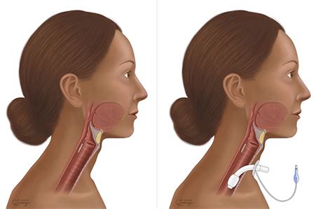 Tracheostomy offers a number of practical advantages compared to translaryngeal intubation, such as a decrease in airway resistance, anatomical dead space, and work of breathing, thus facilitating. Tracheostomy | UI Health