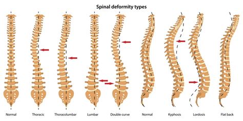 Posture And Curvature Of The Spine Buxton Osetopathy Clinic