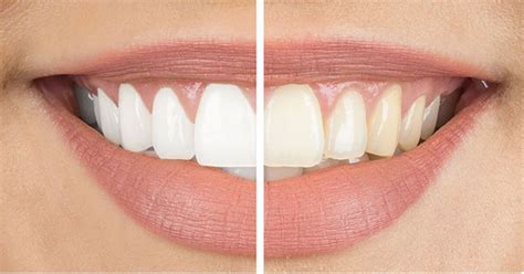 Tips For Natural Teeth Whitening Samples Beauty