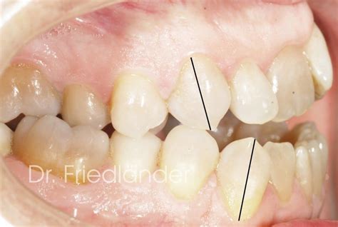 Tipos De Maloclusión Dental Clase I Ii Y Iii