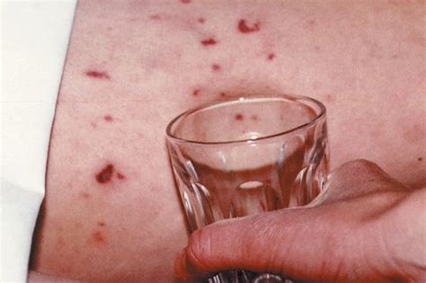 How To Spot Meningitis Rash Early Pictures Banned By Facebook Mirror