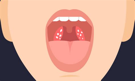 Tonsil Stones Symptoms Causes And Removal Allina Health