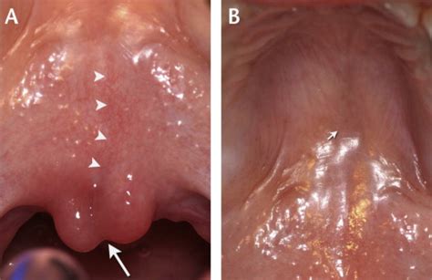 Submucous Cleft Palate With Bifid Uvula The Journal Of Pediatrics