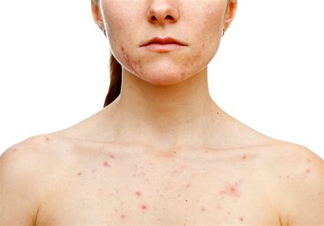 How To Deal With Body Acne Best Body Acne Treatments All About Acne