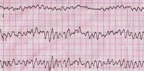 Ventricular Fibrillation Ecg All About Cardiovascular System And