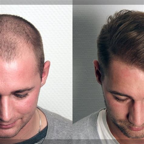 Check spelling or type a new query. شاهد قبل وبعد عملية زراعة الشعر - مع أحمد