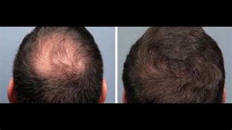 How To Regrow Loss Hair By Onion How To Use Nizoral For Hair Loss