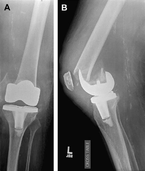 Distal Femoral Replacement Preoperative A Anteroposterior And B
