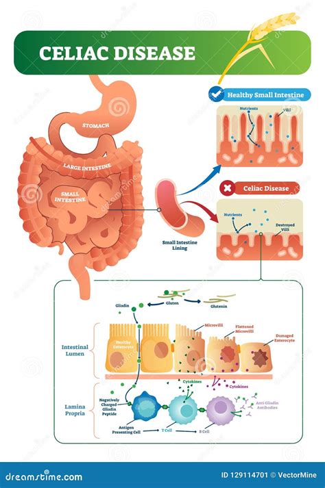 Celiac Disease Pathophysiology