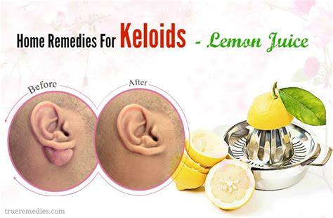 20 Home Remedies For Keloids Scars On Face Ear And Scalp