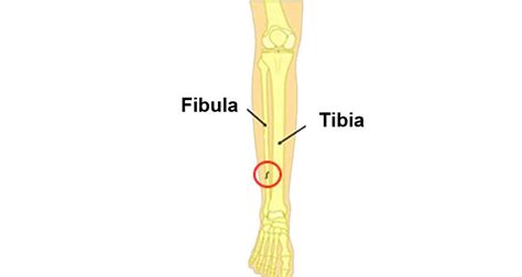 Fibula Stress Fracture Symptoms Causes Treatment And Rehabilitation