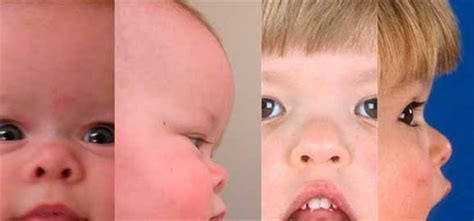 This condition most commonly occurs in infants when a flat nasal bridge and prominent epicanthal folds tend to obscure the nasal portion of the sclera. Flat: Flat Nasal Bridge