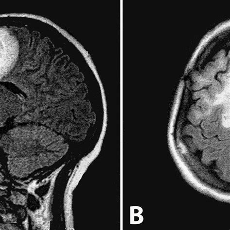 Brain Mri T1 Weighted Images With Contrast Shows A Space Occupying