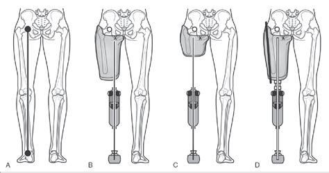 Pdf Transfemoral Amputation Prosthetic Management Semantic Scholar