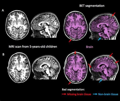 Brain Segmentation Obtained With The Brain Extraction Tool Bet From