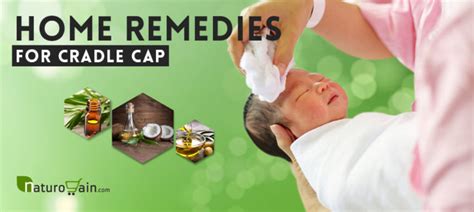 8 Best Home Remedies For Cradle Cap That Work Fast Naturally
