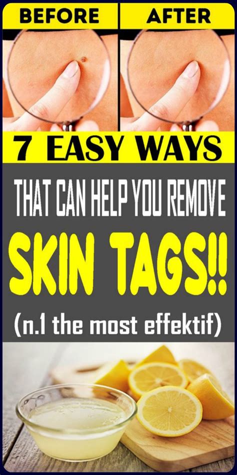 here are 7 easy ways that can help you remove skin tags skin tag removal skin tag natural