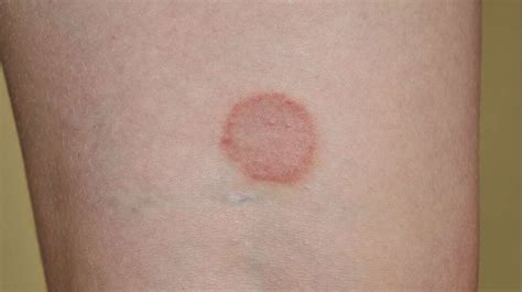 Pityriasis Rosea Treatment Adults