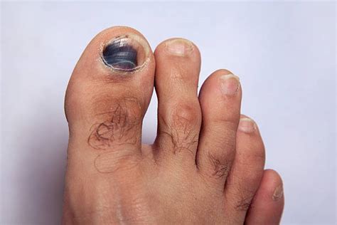 Broken Toe Nail Stock Photos Pictures And Royalty Free Images Istock
