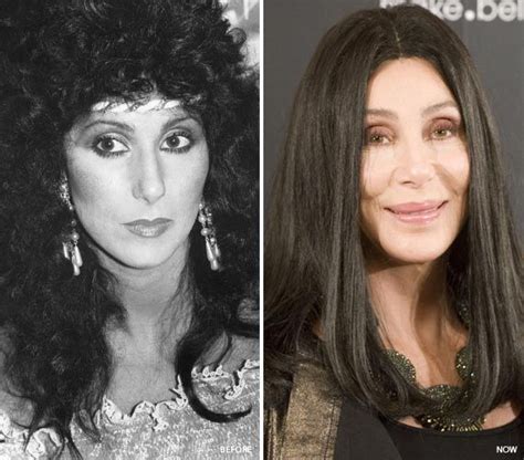 Cher Plastic Surgery Before After Celebrities Before And After
