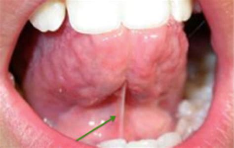 Couper Le Frein De La Langue - Chirurgie orale - Centre de chirurgie orale et d'implantologie du Littoral