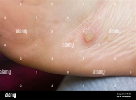Dyshidrotic Eczema On The Foot Blister Dermatitis Close Up Shot Stock