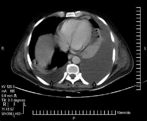 Pathology etiology of pleural effusion. Bilateral pleural effusion: CECT axial section reveals ...