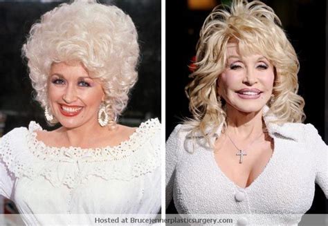 Dolly Parton Plastic Surgery (Bob Job Done) Before After ...
