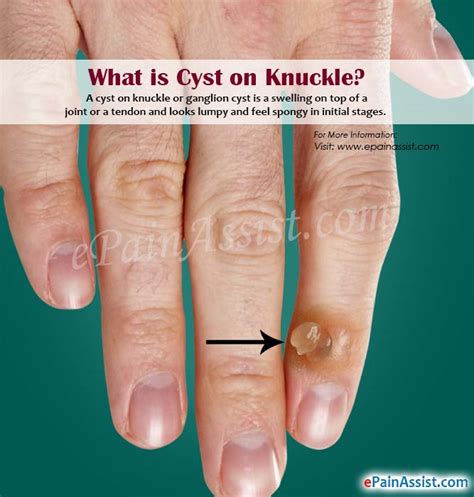 Bumps On Knuckles