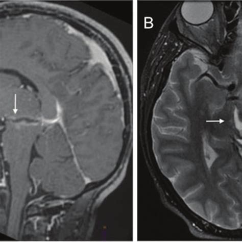 Brain Magnetic Resonance Imaging A Post Contrast Volumetric T1 With