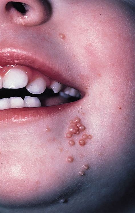 Image Molluscum Contagiosum On A Childs Face Msd Manual