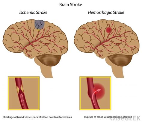 Stroke Ischaemic Causes Symptoms Treatment Stroke Ischaemic