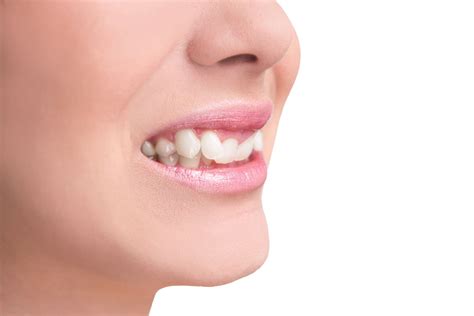 Treatment For A Jutted Tooth Edmonton Ab
