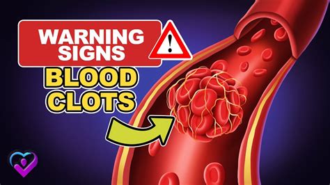 10 Warning Signs Of Blood Clots You Must Not Ignore Youtube