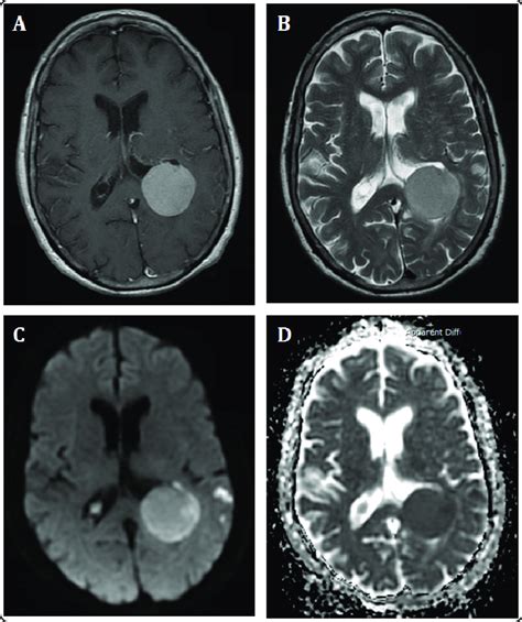 Axial Sections Of A Gadolinium Contrast Enhanced Mri Brain Scan A And