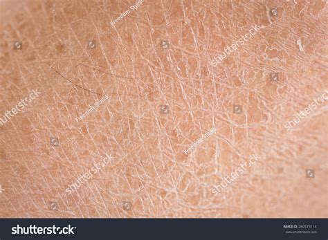 Macro Dry Skin Ichthyosis Detail Stock Photo 260573114 Shutterstock