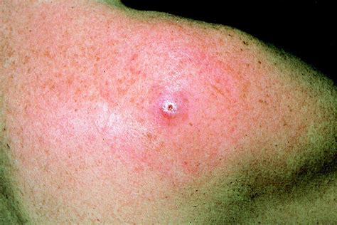 Furuncular Myiasis Caused By Dermatobia Hominis The Human Botfly