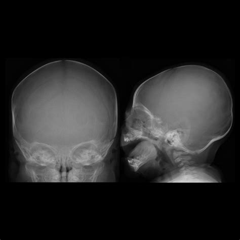 Positional Plagiocephaly Pediatric Radiology Reference Article