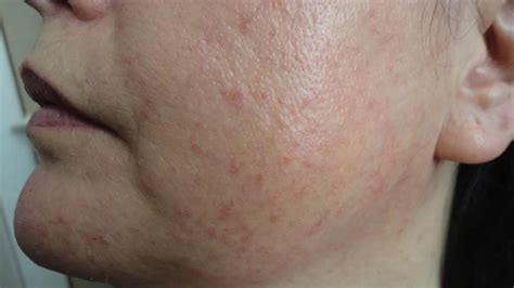 Dermoscopy Of Common Facial Inflammatory Skin Diseases By Dr Aimilios