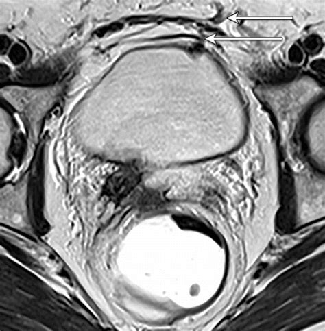 Postoperative Imaging After Surgical Repair For Pelvic Floor