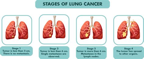 Stages Of Lung Cancer Chart